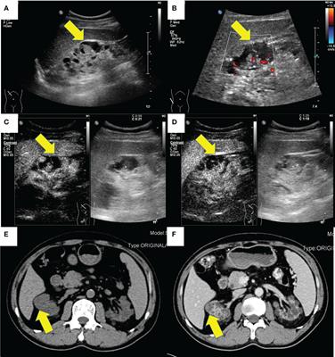 Case Report: The ultrasound features of acquired cystic disease-associated renal cell carcinoma: a case series